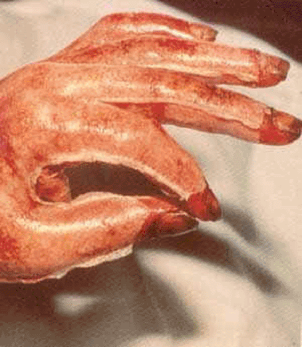 Image: Burn patient wearing a Biobrane glove (photo courtesy BurnSurgery.org)